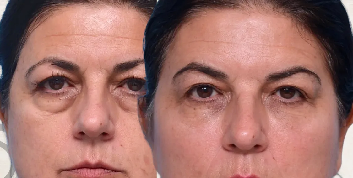 Fillers Ojeras